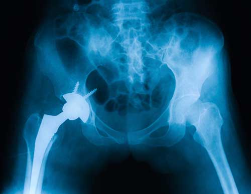 Hip Xray